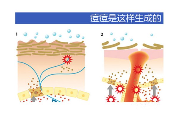 長痘就是排毒嗎？后青春期爆痘多數(shù)是過敏